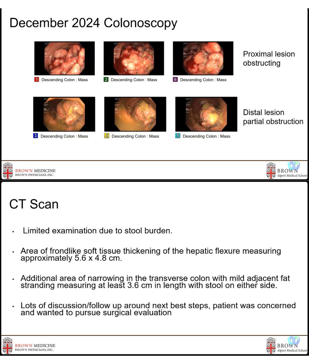 drRobinDud's tweet photo. #IBDlive and case of #cohns that 📈Escalated Quickly from @BrownUniversity
🟧Giant Inflammatory Polyps (#GIP)
🔸size > 1.5cm
🔸CD > UC
🔸rare, can lead to:
- obstruction, intussusception, malignancy
🔸symptoms:
- abdominal pain, diarrhea, bloating
@CleClinicMD @MRegueiroMD