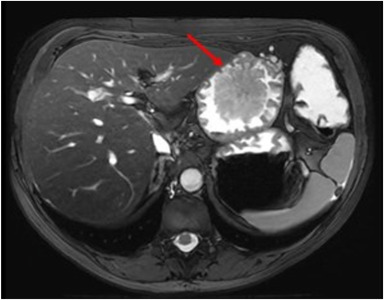 VideoGIE Journal (@videogie) on Twitter photo In this VideoGIE article, Laurens P. Janssens et al use a "Novel large cinching device for the resection of a large pedunculated gastric polyp." videogie.org/article/S2468-…
#GITwitter
<a href="/LJanssensMD/">Laurens Janssens</a> In this VideoGIE article, Laurens P. Janssens et al use a "Novel large cinching device for the resection of a large pedunculated gastric polyp." videogie.org/article/S2468-…
#GITwitter
<a href="/LJanssensMD/">Laurens Janssens</a>