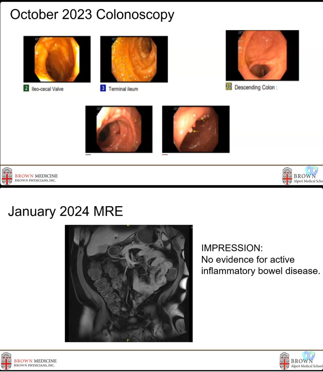 drRobinDud's tweet photo. #IBDlive and case of #cohns that 📈Escalated Quickly from @BrownUniversity
🟧Giant Inflammatory Polyps (#GIP)
🔸size > 1.5cm
🔸CD > UC
🔸rare, can lead to:
- obstruction, intussusception, malignancy
🔸symptoms:
- abdominal pain, diarrhea, bloating
@CleClinicMD @MRegueiroMD
