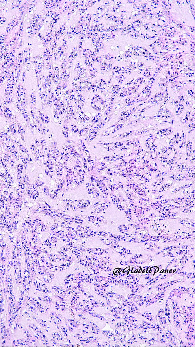 Low power view diagnosis of this renal mass with distinctive morphology? #GUPath #OnePicDx

Answer is all in the picture👇