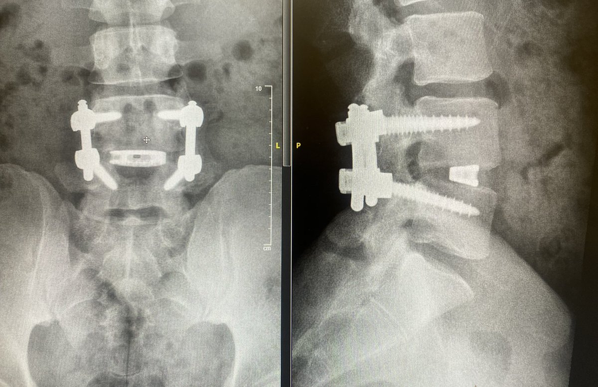 I love a good minimally invasive TLIF. Do many.  But open TLIF, when need better sagittal correction, big mismatch, indirect not enough and need direct visualization of beautifully decompressed nerves bilaterally….is an absolute home run surgery . 
😃 patient .