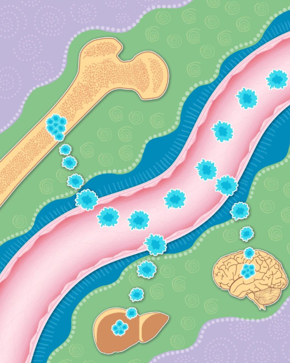 Cancer Discovery (@cd_aacr) on Twitter photo From the April issue: Bone-Induced HER2 Promotes Secondary Metastasis in HR+/HER2- Breast Cancer brnw.ch/21wRUpN
By <a href="/RahatAl93778011/">Rahat Alam</a>, Anna Reva, <a href="/BadoIgor/">Igor Bado</a> and colleagues <a href="/IcahnMountSinai/">Icahn School of Medicine at Mount Sinai</a> <a href="/TischCancer/">The Tisch Cancer Institute</a> From the April issue: Bone-Induced HER2 Promotes Secondary Metastasis in HR+/HER2- Breast Cancer brnw.ch/21wRUpN
By <a href="/RahatAl93778011/">Rahat Alam</a>, Anna Reva, <a href="/BadoIgor/">Igor Bado</a> and colleagues <a href="/IcahnMountSinai/">Icahn School of Medicine at Mount Sinai</a> <a href="/TischCancer/">The Tisch Cancer Institute</a>