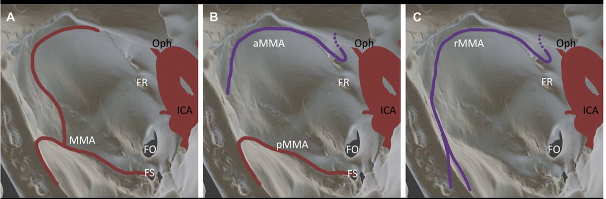 Neurosurgery Publications (@neurosurgerycns) on Twitter photo #ONSNew Absence of Foramen Spinosum on Computed Tomography Scan Determines Feasibility of Middle Meningeal Artery Embolization bit.ly/3EcYDep by Hubbard et al <a href="/MUSC_COM/">MUSC College of Medicine</a> <a href="/CNS_Update/">CNS</a> <a href="/visishs/">Visish M. Srinivasan, MD</a> <a href="/DKondziolkaCNS/">Douglas Kondziolka</a> <a href="/george_maragkos/">George Maragkos, MD</a> #ONSNew Absence of Foramen Spinosum on Computed Tomography Scan Determines Feasibility of Middle Meningeal Artery Embolization bit.ly/3EcYDep by Hubbard et al <a href="/MUSC_COM/">MUSC College of Medicine</a> <a href="/CNS_Update/">CNS</a> <a href="/visishs/">Visish M. Srinivasan, MD</a> <a href="/DKondziolkaCNS/">Douglas Kondziolka</a> <a href="/george_maragkos/">George Maragkos, MD</a>