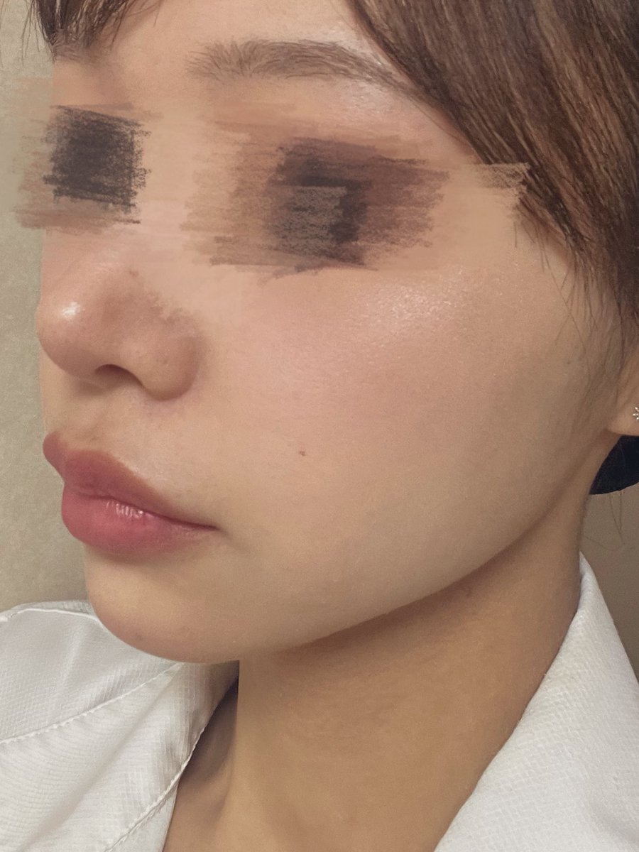 Hitomi_802's tweet photo. アウラ美容整形外科のチュ院長の脂肪吸引
半年が経過しました！

ぼこつきや違和感は全くなくなり、理想的な輪郭になれました！斜めから見た時の輪郭のはっきりした感じがとても満足しています😊 https://t.co/BCrqufjVY1