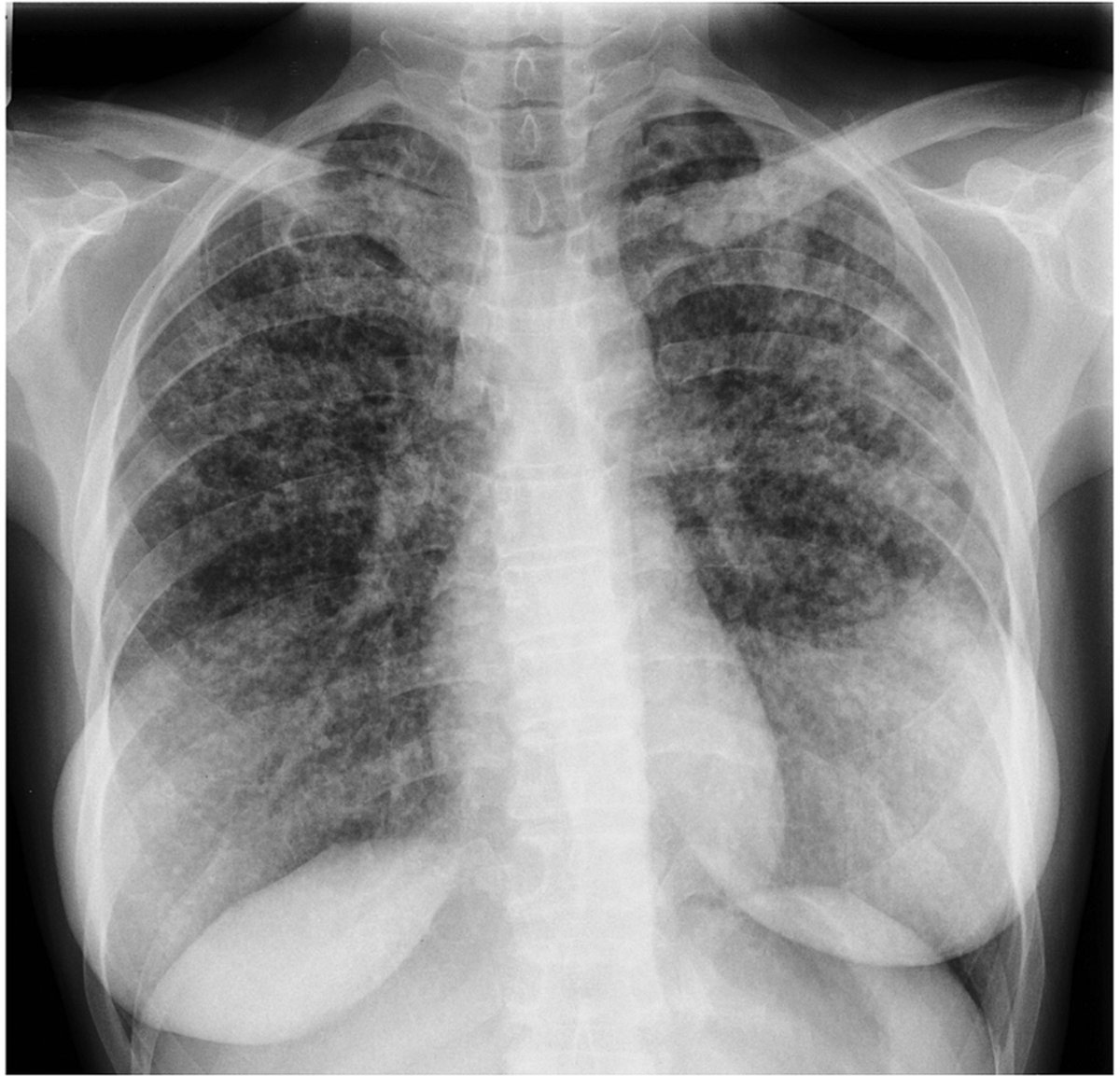 IhabFathiSulima's tweet image. A 46 lady with 
#fever and #cough.
What are the findings?
Was on #immunosuppression drugs for #rheumatoid_Arthritis.
What has happened ⁉️
