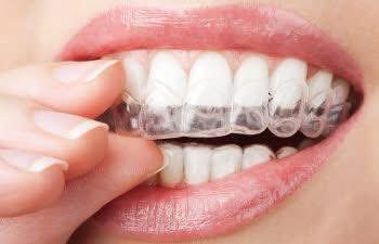 At Smiles by Seese in Davidson, we understand that managing gum disease is a significant concern for many of our patients. If traditional braces are causing you concern becuase of a gum disease issue, Invisalign is a compelling alternative!  Talk to Dr Seese at your next visit!