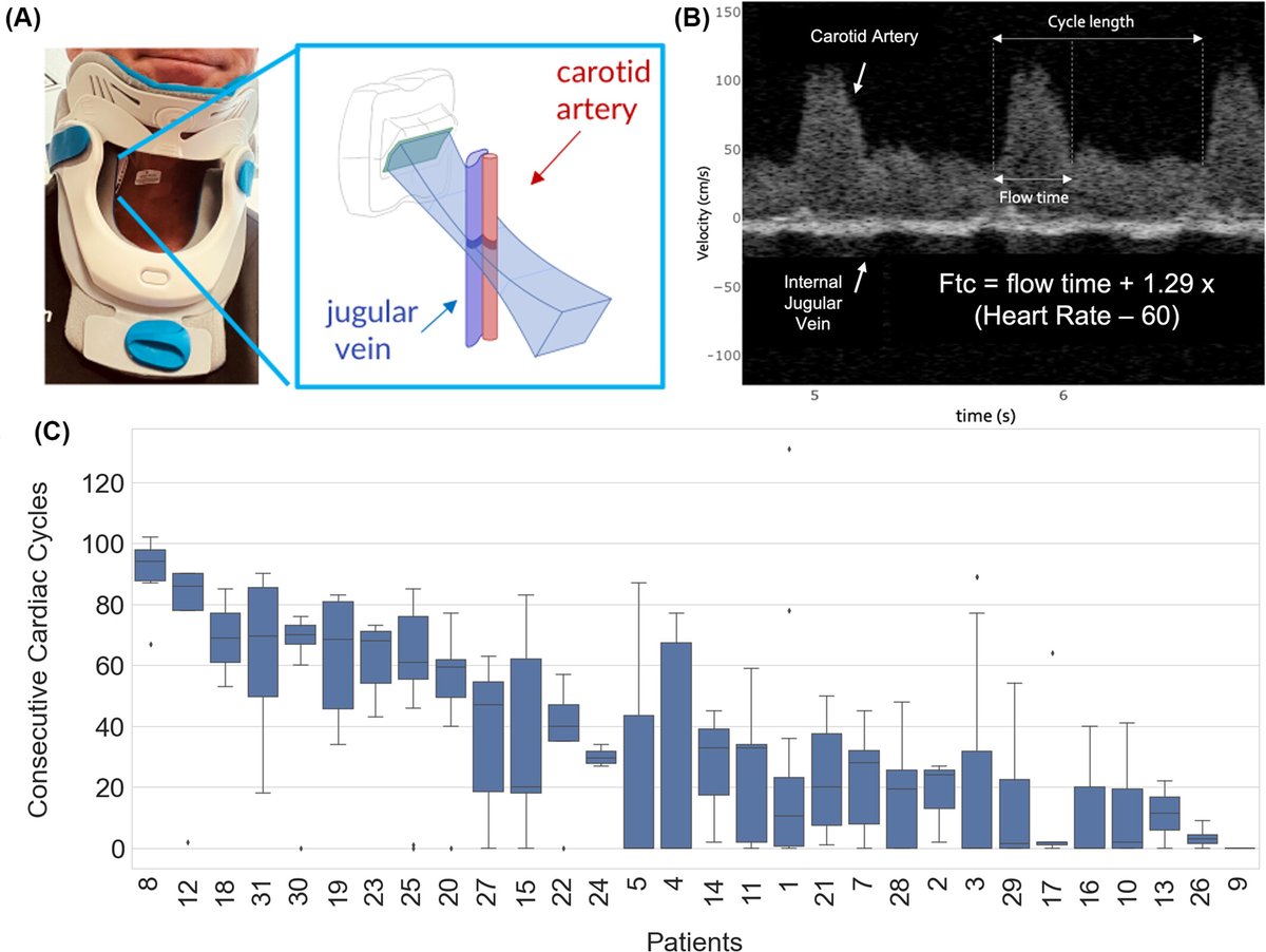 FloPatch | Flosonics Medical (@flosonics) on Twitter photo New in Transfusion: Da Luz et al. have publish the first trauma-focused feasibility study evaluating FloPatch, in collaboration with <a href="/Sunnybrook/">Sunnybrook Health Sciences Centre</a>.
Key findings:
• Lower ccFT values were associated with transfusion need, greater injury severity, and longer ICU/hospital stays. New in Transfusion: Da Luz et al. have publish the first trauma-focused feasibility study evaluating FloPatch, in collaboration with <a href="/Sunnybrook/">Sunnybrook Health Sciences Centre</a>.
Key findings:
• Lower ccFT values were associated with transfusion need, greater injury severity, and longer ICU/hospital stays.