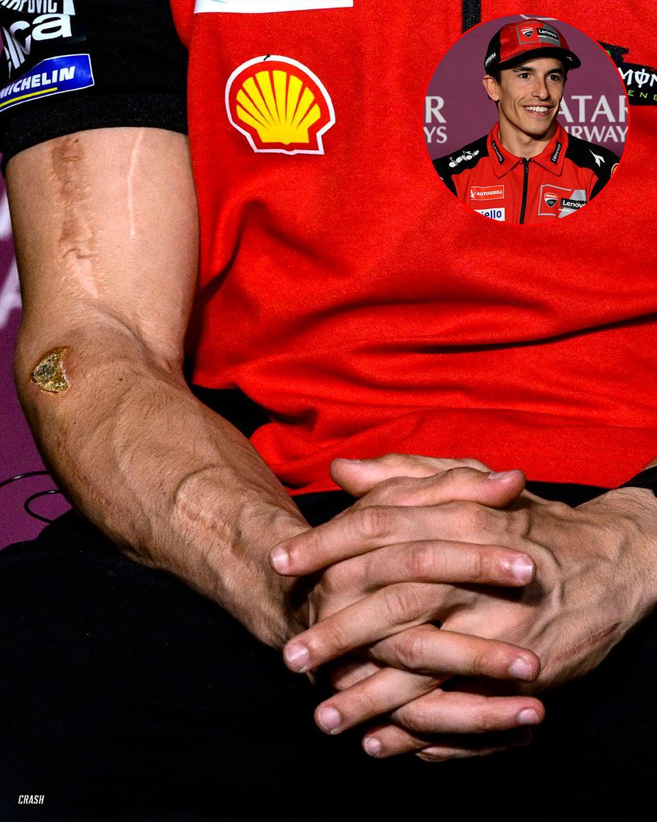 crash_motogp's tweet photo. The cut and scars on Marc Marquez's right arm 😯

#MotoGP #QatarGP https://t.co/uOhAjqwR5y