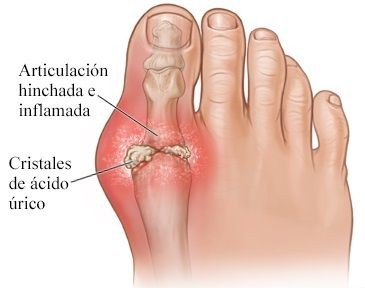 LatidosDePasion's tweet photo. ¡El dolor que puede atacar en cualquier momento!

La gota, "la enfermedad de los reyes", puede arruinar tu vida. 

Descubre cómo prevenirla y tratarla antes de que sea demasiado tarde. 

👇🧵 https://t.co/JLW6zWwS5f