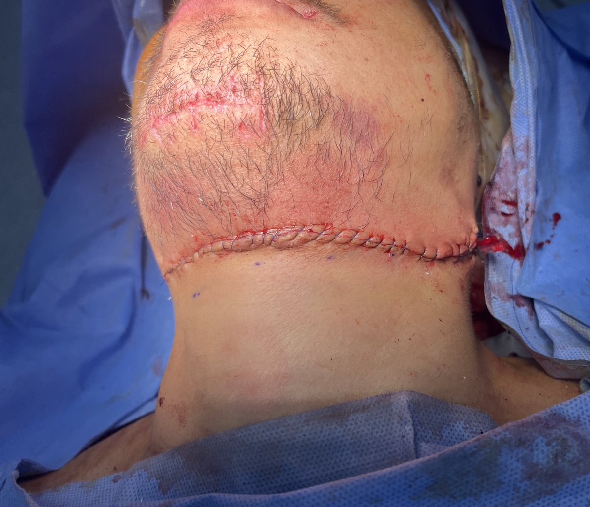 A case of Pedestrian RTA with comminuted symphyseal fracture with ramus fracture, and Rt ZF fracture 

The mandibular fractures were managed with 2.7mm reconstruction plate with 2.0mm miniplate with a one lag screw♥️