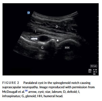 Read this review on sport-related neuropathies like traumatic irritation of the brachial plexus or cervical roots (“Burners and stingers,”) suprascapular, axillary neuropathies, UNE in throwers, UNW in cyclists, and foot/ ankle neuropathies including TTS. onlinelibrary.wiley.com/doi/epdf/10.10…
