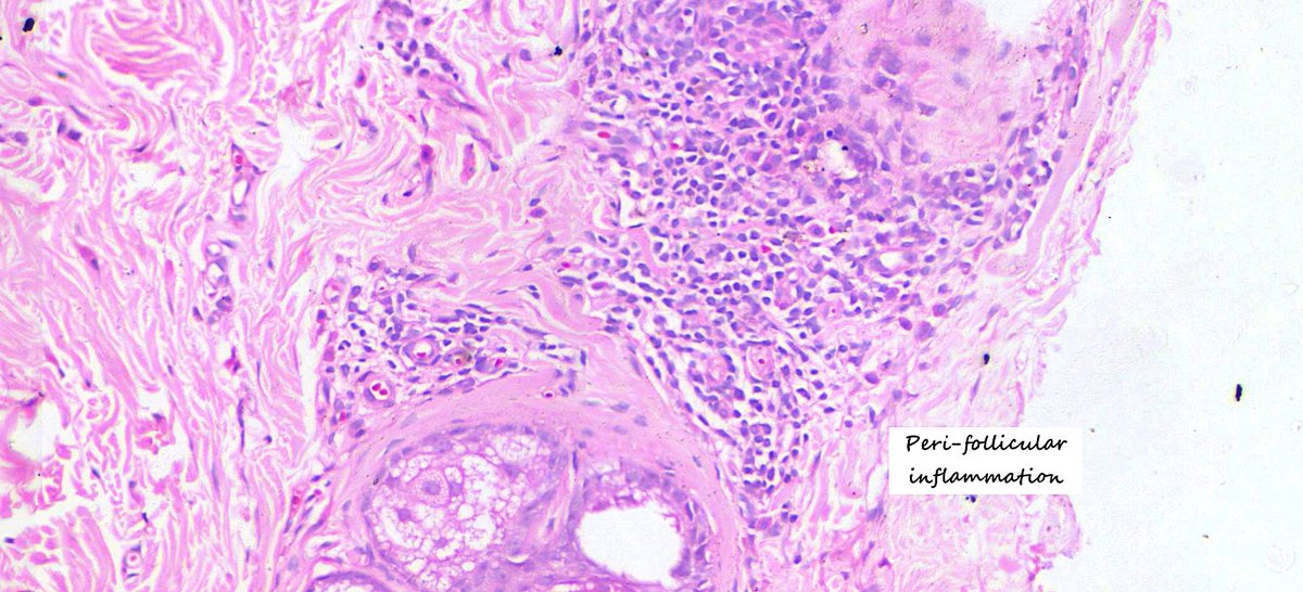 Found an amazing case of Dowling Dego's disease with a positive family history.

#dermpath #pathtwitter