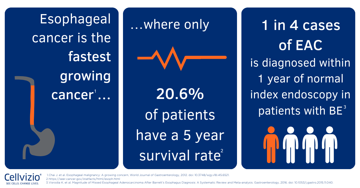 BE is the only known precursor of EAC, thus adequate surveillance EGD procedures are vital to avoid the progression to more serious disease states. During #EsophagealCancerAwarenessMonth, discover the power of an early &amp; accurate diagnosis with #Cellvizio: hubs.la/Q03gNfcm0