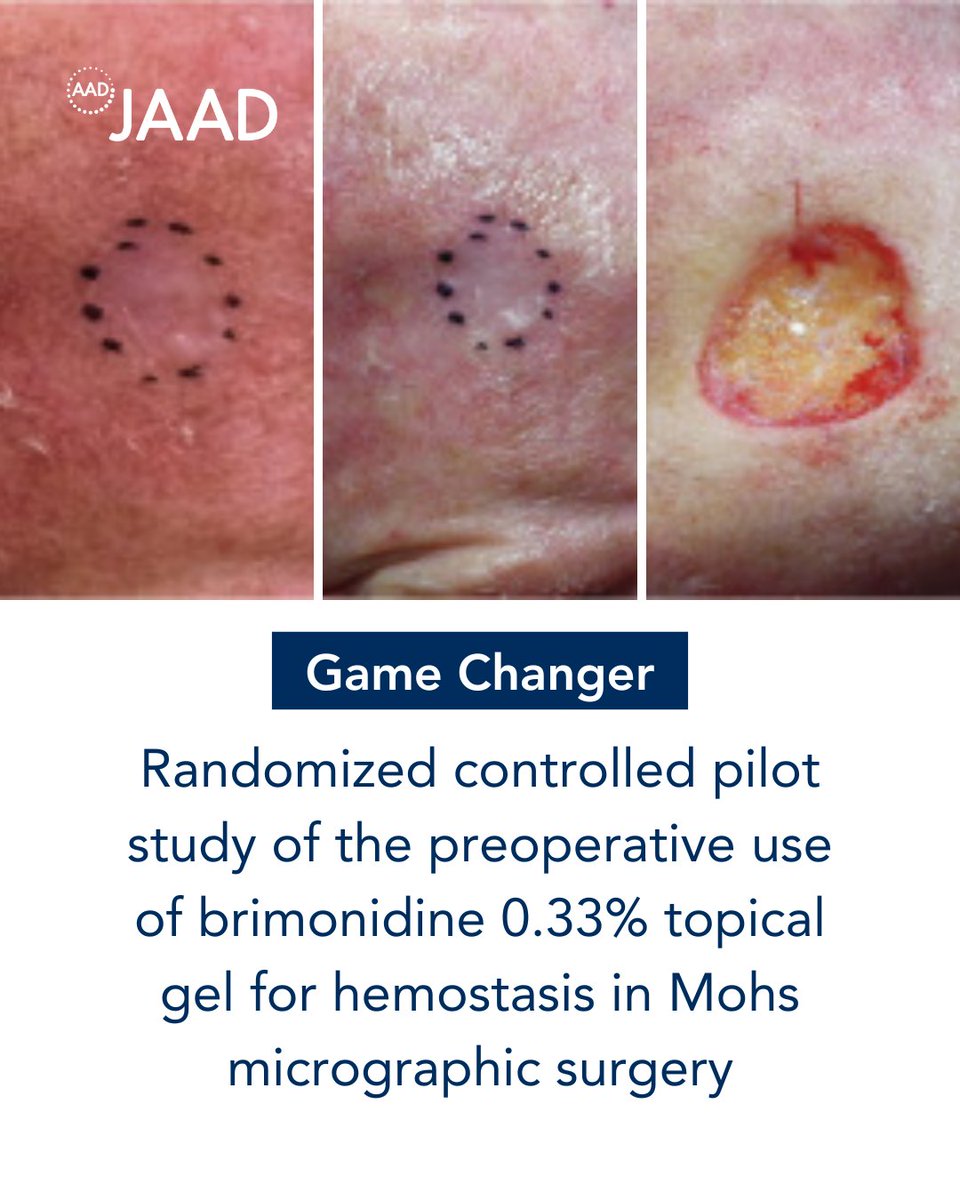 Q: How did this study impact dermatology? A: Preoperative 0.33% brimonidine gel reduced blood loss &amp; electrocautery need in Mohs surgery for patients on anticoagulants. Its vasoconstricting properties make it a hemostatic agent worth investigating. bit.ly/3G2rzXj