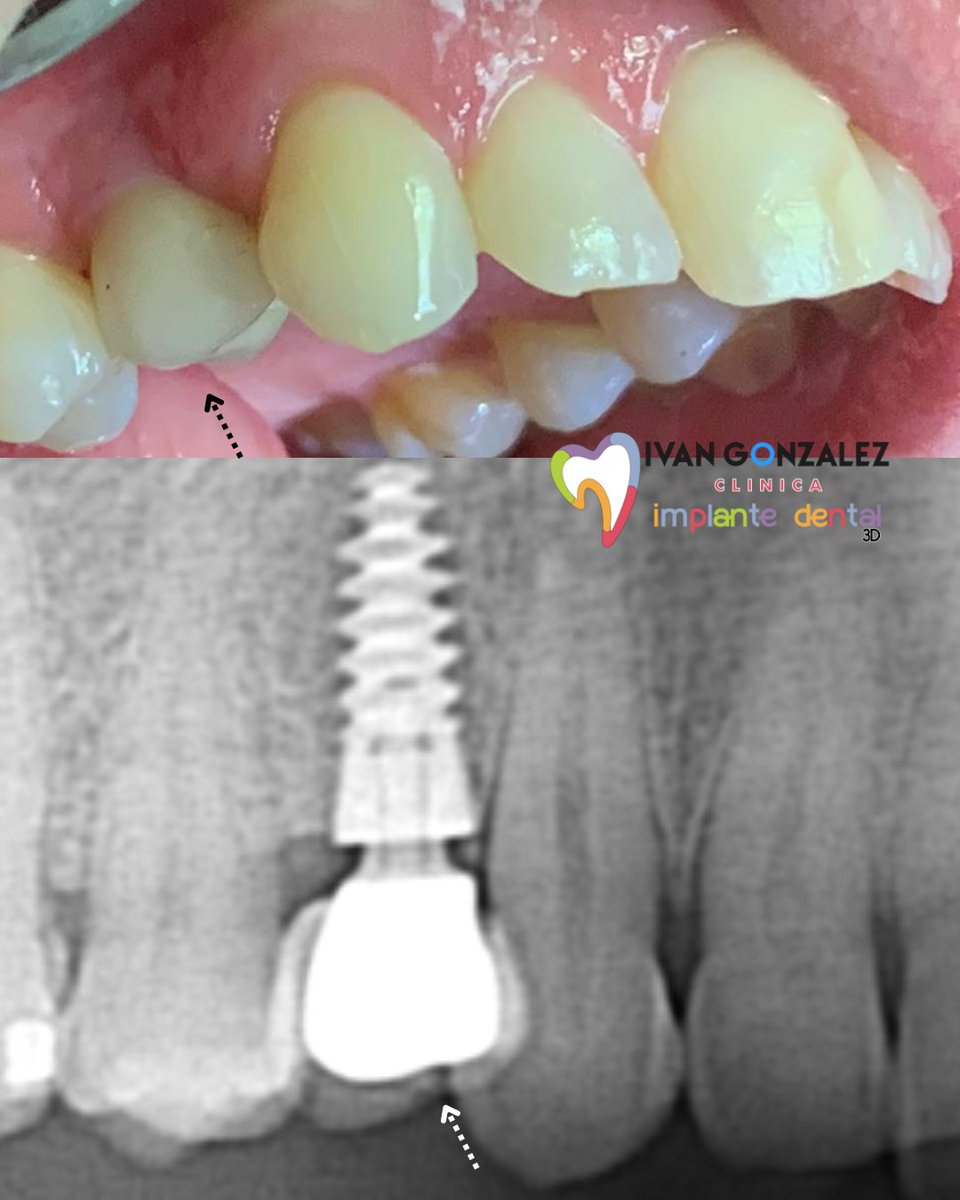 ivangonzalez_dr's tweet photo. Diente de circonio sobre implante en premolar, justo detrás del canino. Estática 100% natural, para una sonrisa perfecta
.
+INFO 673 149 050 WhatsApp
#málaga #labios #voluminizacióndelabios #dental #clínica #blanqueamiento #implante https://t.co/GMy727i1ym