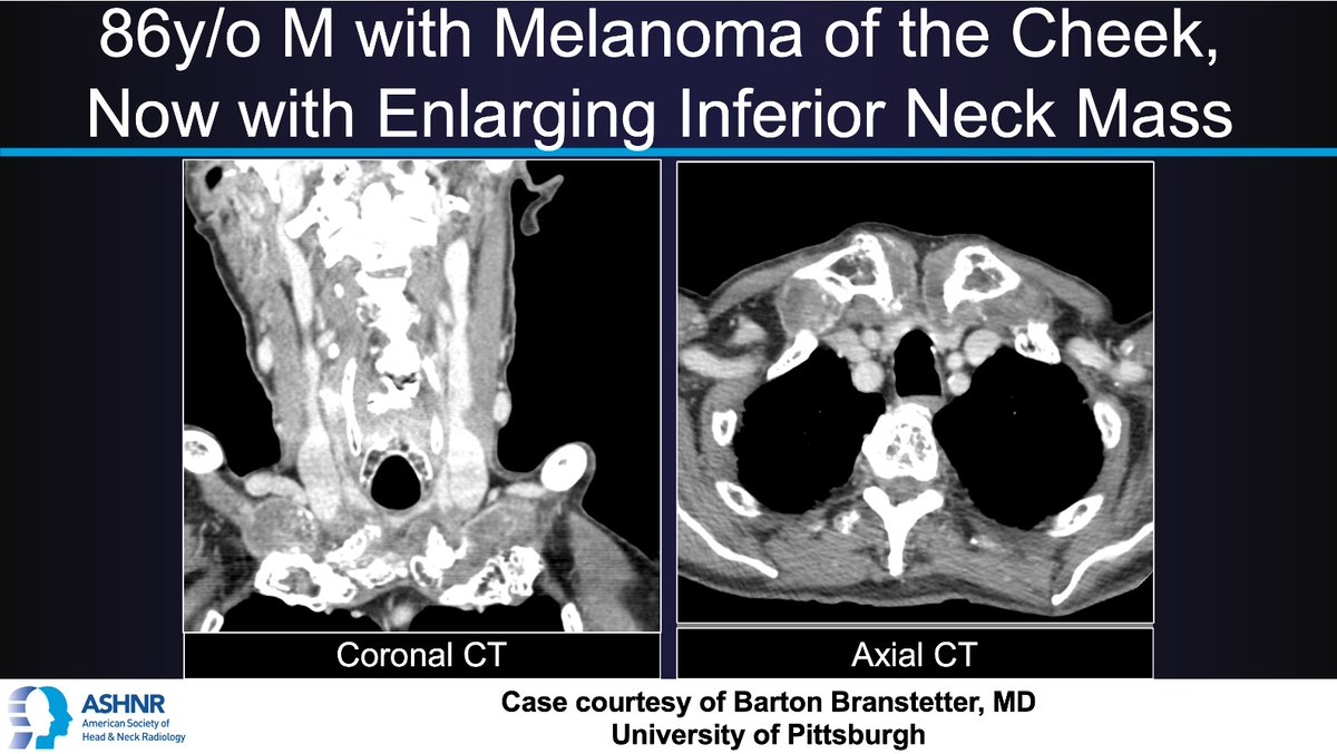 ASHNR (@ashnrsociety) on Twitter photo #ASHNRCOTW #292: Neck Mass. Thx <a href="/CharBranstetter/">Char Branstetter</a> 4 case! #ASHNR25
Answer w/ appropriate GIF only -- stay professional & don't spoil it!
<a href="/callyrobs/">Caroline Robson, MBChB</a> <a href="/DShatzkes/">Deborah Shatzkes</a> <a href="/CDP_Rad/">C Douglas Phillips ๐บ๐ธ</a> <a href="/rhwiggins/">Richard Wiggins</a>
<a href="/nakoontz/">Nicholas Koontz</a> <a href="/KRileyMD/">Kalen Riley</a> <a href="/CMGlastonbury/">Christine M Glastonbury, MD</a>
<a href="/tabby_kennedy/">Tabby A. Kennedy, MD</a> <a href="/PhilipRChapman1/">Philip R. Chapman, MD</a> <a href="/cmtomblinson/">Courtney Tomblinson, MD</a>
<a href="/amyfjuliano/">Amy Juliano</a> #ASHNRCOTW #292: Neck Mass. Thx <a href="/CharBranstetter/">Char Branstetter</a> 4 case! #ASHNR25
Answer w/ appropriate GIF only -- stay professional & don't spoil it!
<a href="/callyrobs/">Caroline Robson, MBChB</a> <a href="/DShatzkes/">Deborah Shatzkes</a> <a href="/CDP_Rad/">C Douglas Phillips ๐บ๐ธ</a> <a href="/rhwiggins/">Richard Wiggins</a>
<a href="/nakoontz/">Nicholas Koontz</a> <a href="/KRileyMD/">Kalen Riley</a> <a href="/CMGlastonbury/">Christine M Glastonbury, MD</a>
<a href="/tabby_kennedy/">Tabby A. Kennedy, MD</a> <a href="/PhilipRChapman1/">Philip R. Chapman, MD</a> <a href="/cmtomblinson/">Courtney Tomblinson, MD</a>
<a href="/amyfjuliano/">Amy Juliano</a>