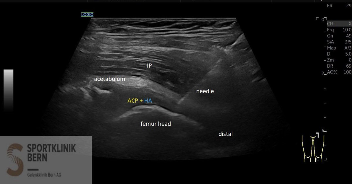 SportklinikBern's tweet photo. #Ultrasoundguidedinjection with #arthrexprp and #ostenilplus for severe #hiparthrosis - #mskus #pocus #pocushub #GElogiqE10sr4 https://t.co/RPRYz1DrO1