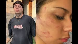 CostaRoja_'s tweet photo. Nunca seré un APAÑADOR DE GOLPEADORES DE MUJERES como este enfermo @diealiss , no es una simple funa, el imb3cil FUE SENTENCIADO, y no solo  golpeo a una, GOLPEO A MAS MUJERES, o sea en reincidente.
Y los que apañan o sienten empatía por estas lacras: EL KARMA  HARA SU TRABAJO😝 https://t.co/QSQF0c1dU1
