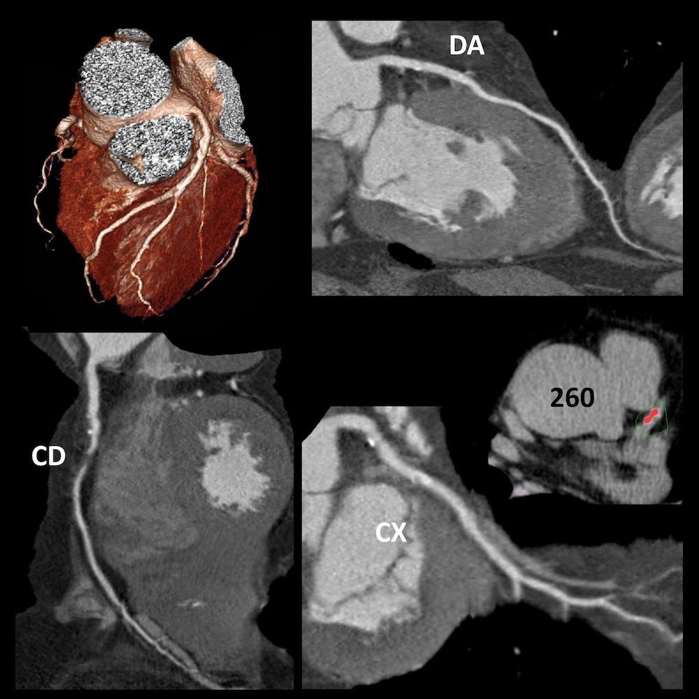 ImagenCardiaca's tweet photo. Los #miniCASOS de Cardio TC más vistos de nuestra (breve) historia
Cardio TC #8 - Oclusión coronaria
🔎 https://t.co/Xs5QDYE31K ◀️
#aprendeconcasos https://t.co/WlbplxR4XB