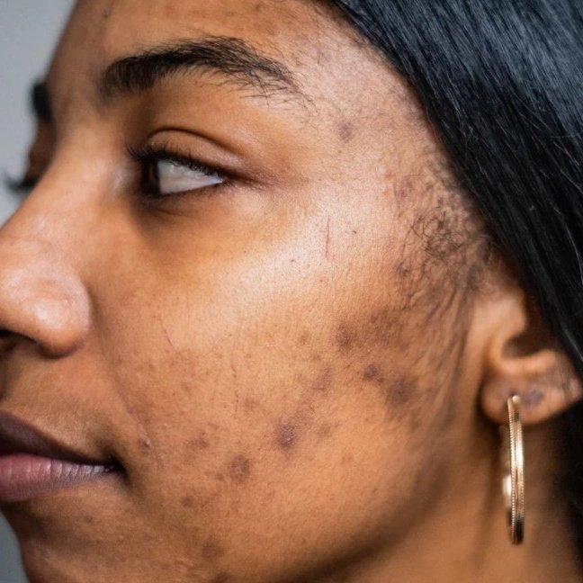 DedayoRoots's tweet image. Natural Remedy for ACNE SCAR 👇 

🌱Take 1-2 teaspoon of lemon juice 🍋 and ½ teaspoon of raw honey 🍯

- Mix well, apply on the affected areas.
- Let it dry and rinse off with water.
- Repeat daily.

#Dédayọ̀Roots #BackToRoots #StayRooted