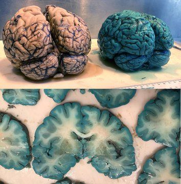 Todo el mundo habla de los increíbles beneficios del AZUL DE METILENO, pero pocos analizan sus riesgos OCULTOS:

• Alteración de los IMAO
• Muerte de bacterias intestinales
• Sobreestimulación dopaminérgica

Aquí está la verdad completa sobre MB: