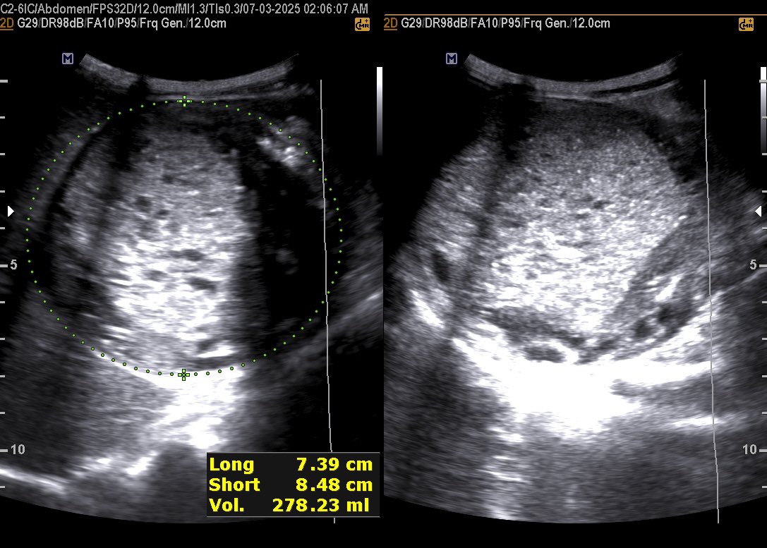 EchoTech_4's tweet photo. 6 years male patient presented with Right side and epigastric Palpable mass.
Your opinion?
#Echo_Tech https://t.co/wKjGZjyEFg