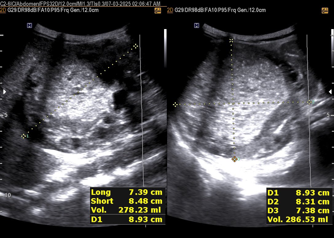 EchoTech_4's tweet photo. 6 years male patient presented with Right side and epigastric Palpable mass.
Your opinion?
#Echo_Tech https://t.co/wKjGZjyEFg
