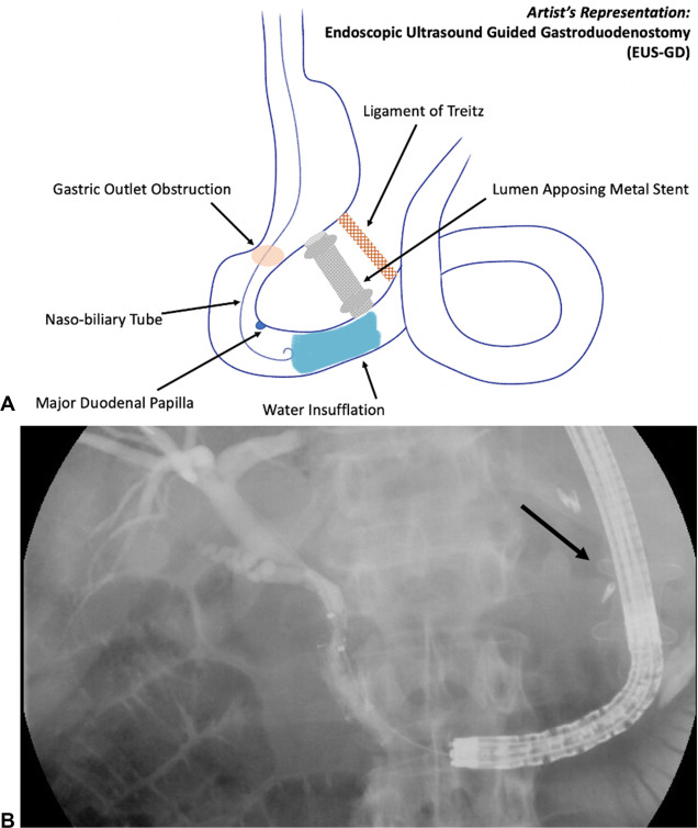 GIE (@gie_journal) on Twitter photo In Focused Communications, Kesar et al apply "EUS-directed transduodenal ERCP in concomitant gastric outlet and biliary obstruction." giejournal.org/article/S0016-…
#GITwitter
<a href="/WilliamAbelMD/">William F. Abel, MD</a> <a href="/VKesarMD/">Varun Kesar</a> @Kmonkemuller <a href="/PaulYeaton/">Paul Yeaton</a>
<a href="/yaransarkis/">Yara Sarkis, MD</a> In Focused Communications, Kesar et al apply "EUS-directed transduodenal ERCP in concomitant gastric outlet and biliary obstruction." giejournal.org/article/S0016-…
#GITwitter
<a href="/WilliamAbelMD/">William F. Abel, MD</a> <a href="/VKesarMD/">Varun Kesar</a> @Kmonkemuller <a href="/PaulYeaton/">Paul Yeaton</a>
<a href="/yaransarkis/">Yara Sarkis, MD</a>