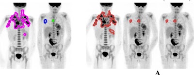 Radiology_AI's tweet photo. LAS-NET: a longitudinally aware segmentation network for automatic quantification of serial PET scans https://t.co/uXFISrXvB1 @SocPedRad #SPR25 #PedsRad #radiology https://t.co/iwByHIU1uS
