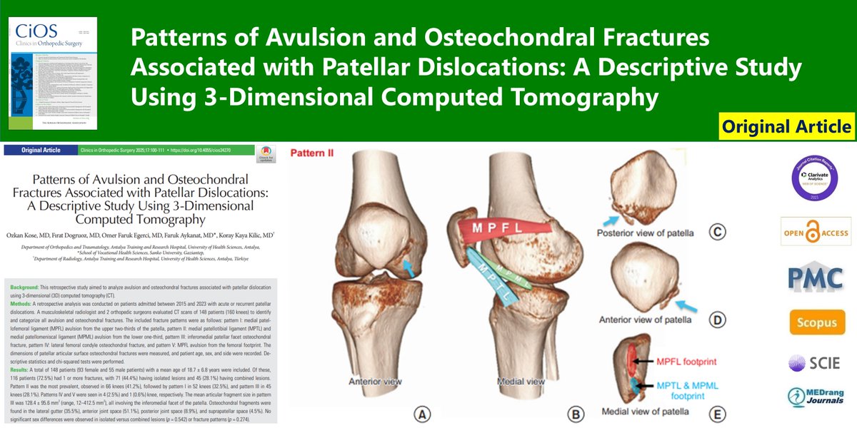 Patterns of Avulsion and Osteochondral Fractures Associated with Patellar Dislocations: A Descriptive Study Using 3-Dimensional Computed Tomography
🌷doi.org/10.4055/cios24…
2025 Feb;17(1)Ozkan Kose
#Patellofemoral_joint #Patellar_dislocation #Joint_instability #Patellar_ligament