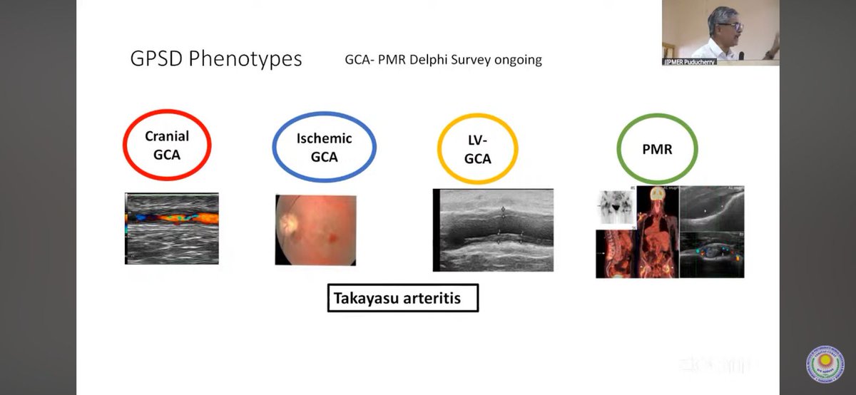 Molly (@drmollythabah) on Twitter photo Takeaways from <a href="/profbdasgupta/">Bhaskar Dasgupta</a> Professor Dasgupta's brilliant talk on GCA-PMR spectrum disease (GSPD), on 9 April JIPMER <a href="/OfficialJipmer/">JIPMER - Official</a> <a href="/AishuGopal/">Aishwarya G</a>
- Bring order in to a disorder
- Recognise the phenotypes Takeaways from <a href="/profbdasgupta/">Bhaskar Dasgupta</a> Professor Dasgupta's brilliant talk on GCA-PMR spectrum disease (GSPD), on 9 April JIPMER <a href="/OfficialJipmer/">JIPMER - Official</a> <a href="/AishuGopal/">Aishwarya G</a>
- Bring order in to a disorder
- Recognise the phenotypes