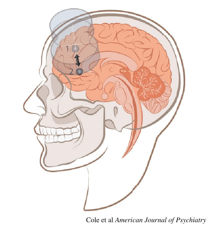 Clayton Coleman (@ccoleman_neuro) on Twitter photo My hypothesis was inspired by an episode of the <a href="/hubermanlab/">Andrew D. Huberman, Ph.D.</a> podcast with <a href="/NolanRyWilliams/">Nolan Williams</a> where they discussed advances in rapid Transcranial Magnetic Stimulation (rTMS) for the treatment of depression utilizing the SAINT protocol. (3/12) My hypothesis was inspired by an episode of the <a href="/hubermanlab/">Andrew D. Huberman, Ph.D.</a> podcast with <a href="/NolanRyWilliams/">Nolan Williams</a> where they discussed advances in rapid Transcranial Magnetic Stimulation (rTMS) for the treatment of depression utilizing the SAINT protocol. (3/12)