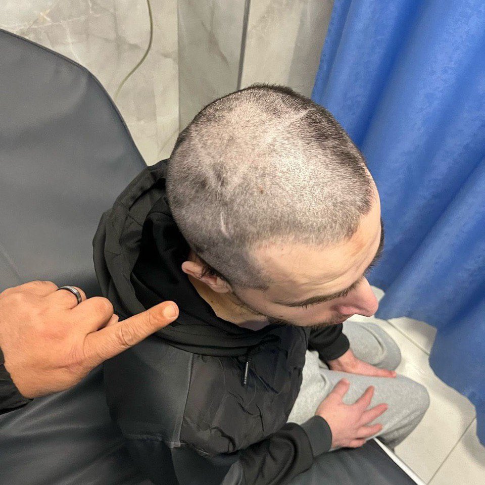 Israeli forces carved a Star of David into the head of freed detainee Musab Qatawi from Qalqilya, released today after 3 years in Israeli prison.
