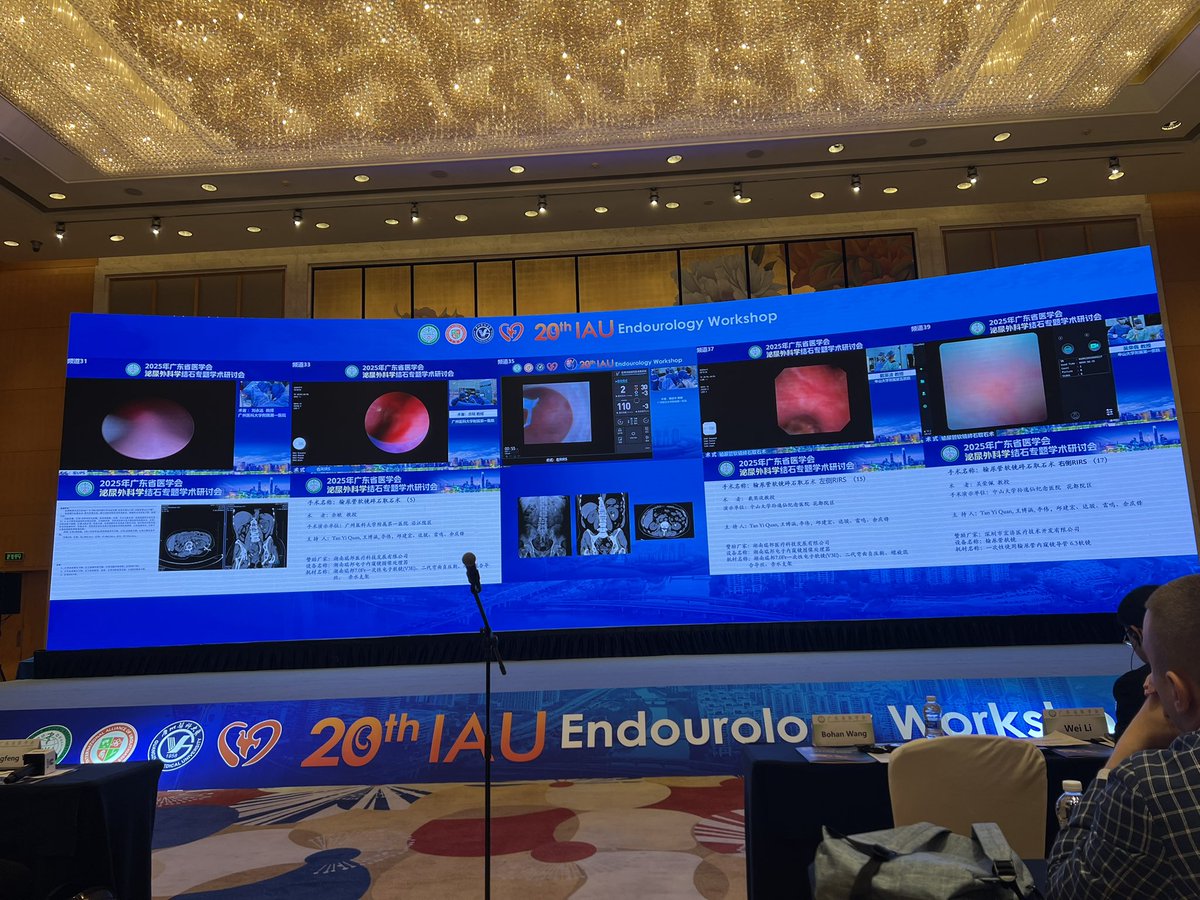 Kazumi Taguchi (@kazumi_taguchi) on Twitter photo Incredible 5 simultaneous live surgeries at the 20th International Alliance of Urolithiasis Workshop <a href="/Guangzhou_City/">Guangzhou China</a> Prof <a href="/zeng_guohua/">Guohua Zeng</a> is using FANS and Prof. Jianxing Li is about to start US-guided PCNL. Busy not to miss these masterclass cases! #endourology #UroSoMe Incredible 5 simultaneous live surgeries at the 20th International Alliance of Urolithiasis Workshop <a href="/Guangzhou_City/">Guangzhou China</a> Prof <a href="/zeng_guohua/">Guohua Zeng</a> is using FANS and Prof. Jianxing Li is about to start US-guided PCNL. Busy not to miss these masterclass cases! #endourology #UroSoMe
