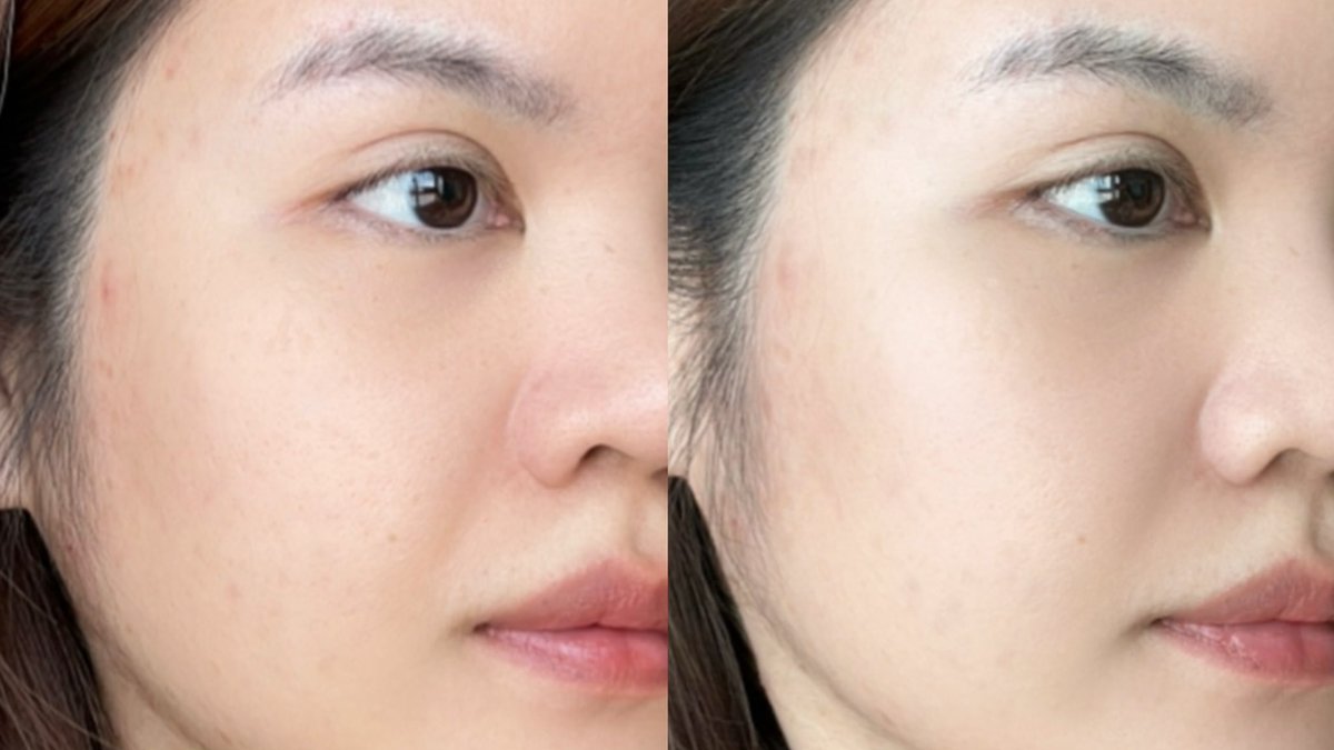 อีกหนึ่งโฟมล้างหน้าที่ถูกและดียกให้ Mentholatum Acnes สูตรนี้เลย เอาจริงๆฉันซื้อเพราะแม้กณฐ 5555 เขินเขาจับแก้มกัน อยากซัพพอร์ต แต่พอได้ลองจริงๆคือชอบเลย ช่วยทั้งลดสิว ลดรอย ผิวชุ่มชื้น หลังล้างหน้าผิวไม่แห้งตึงด้วย และตัวนี้เค้ายังช่วยปลอบประโลมผิวได้ดีอีก เพราะเป็นเวชสำอางธรรมชาติ 

#เมนโทลาทั่มแอคเน่ส์ #โฟมลดสิว #SkinRoutine