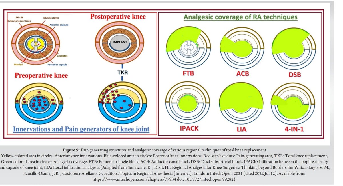 Dr.Kartik Sonawane (@kartikbsonawane) on Twitter photo "Shifting the Pain Paradigm in TKA"
#TKAInsights #PainPathways #RegionalAnesthesia #PostoperativePain #KneeSurgery #GenicularBlock #ExtraArticularPain #PeriarticularTargets #SmartAnalgesia #OrthoAnesthesia #AnesthesiaTips #PainManagement #PrehabToRehab
Tip of the Day:
Before "Shifting the Pain Paradigm in TKA"
#TKAInsights #PainPathways #RegionalAnesthesia #PostoperativePain #KneeSurgery #GenicularBlock #ExtraArticularPain #PeriarticularTargets #SmartAnalgesia #OrthoAnesthesia #AnesthesiaTips #PainManagement #PrehabToRehab
Tip of the Day:
Before
