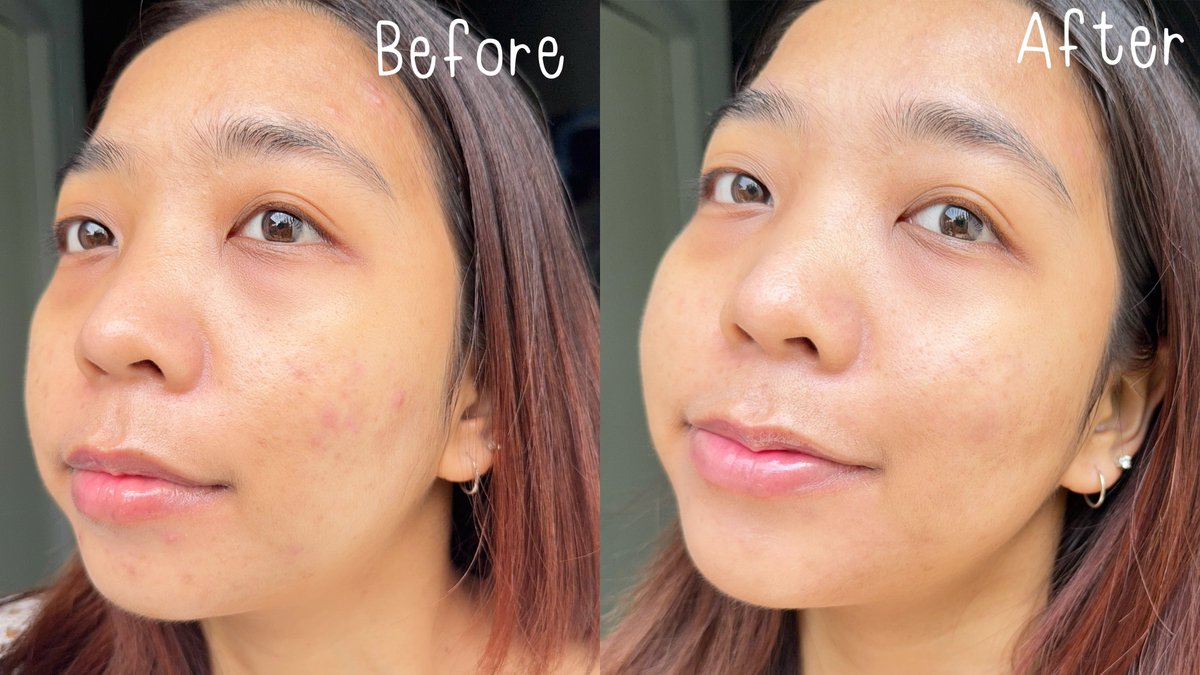 โฟมลดสิวเวชสำอางที่ใช้มาตลอด Mentholatum Acnes Deep Wash Cleanser เมื่อก่อนเคยสิวเยอะกว่านี้มากกกก เดี๋ยวนี้จะขึ้นนิดๆหน่อยๆช่วงเมนส์มา เค้ามีสารสกัดที่ช่วยลดสิวอุดตันและสิวอักเสบ แถมยังมี Whiteclay ช่วยคุมมัน ดูดซับความมันได้ดีด้วย  ใช้แล้วรู้สึกว่าหน้าสะอาด ไม่มันไม่แห้งตึง ฟองโฟมนุ่ม ไม่บาดผิว หาซื้อได้ง่ายๆที่ 7-11 น้าาา 😻 #โฟมลดสิวผิวมัน #เมนโทลาทั่มแอคเน่ส์ #โฟมลดสิวเซเว่น
