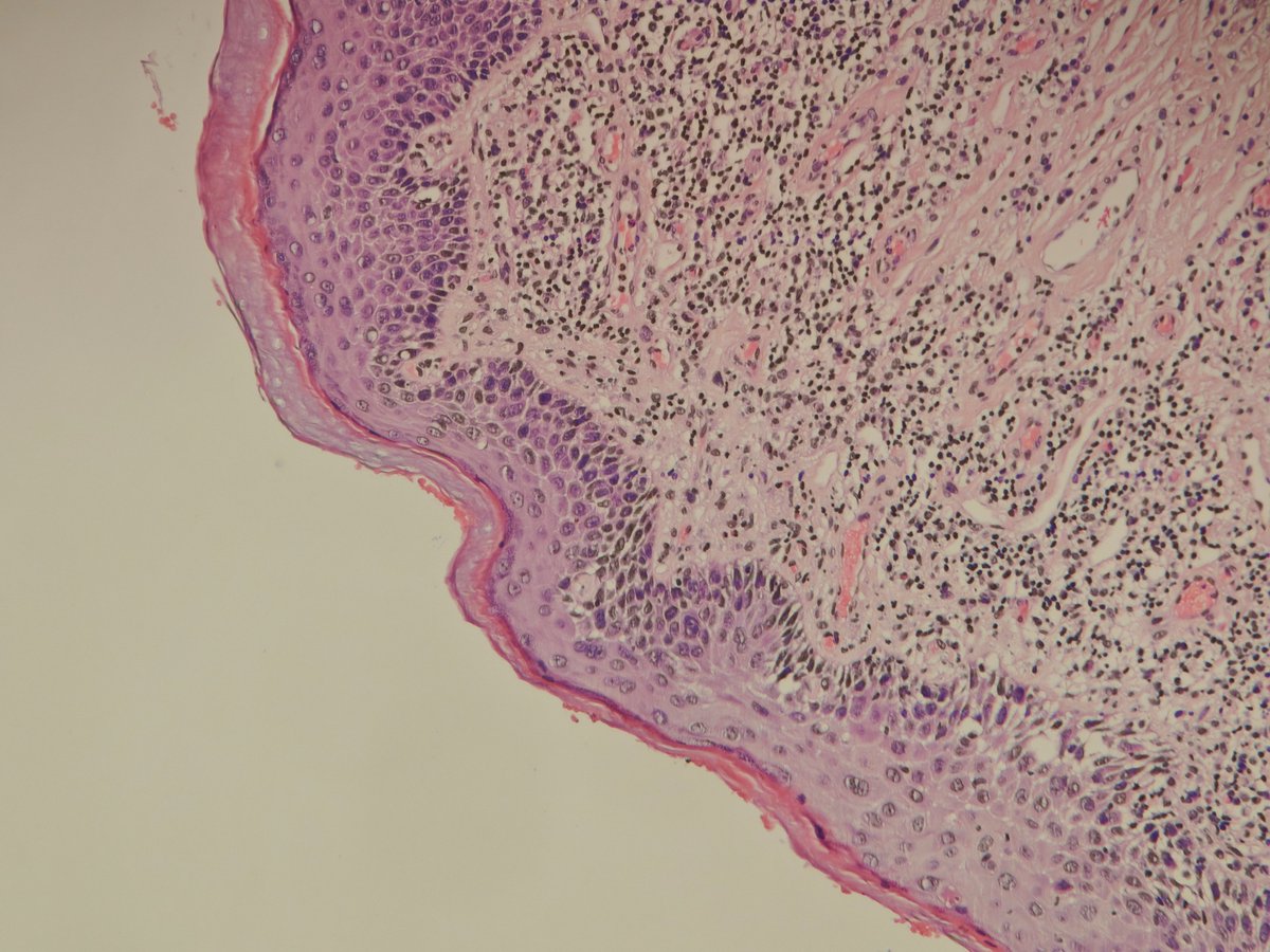 MirunaPopescu13's tweet image. HPV-independent (differentiated) VIN.
➡️ Retained maturation
➡️ Atypia limited to basal and parabasal layers (🔺-shaped atypical basal keratinocytes with prominent intercellular bridges)
➡️ Hyperparakeratosis
#IHCPath basally overexpressed, mutant p53

#PathTwitter #Gynpath
