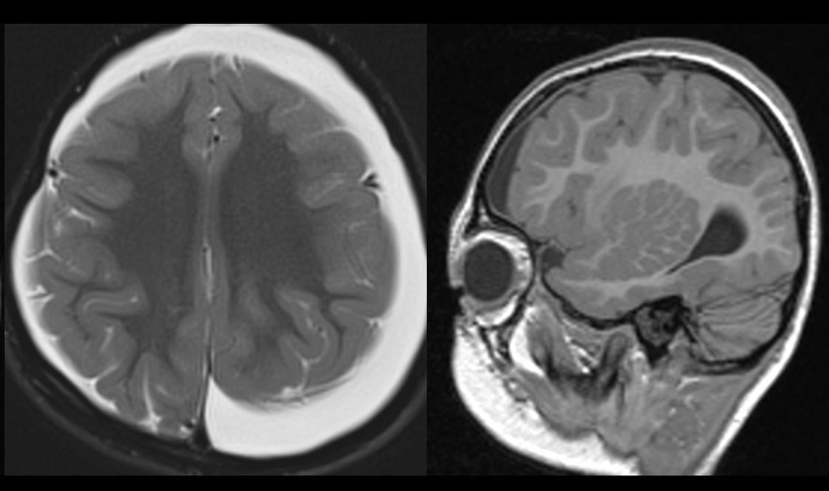 SPIN | Society of Pediatric Neuroimaging (@spinacademics) on Twitter photo This weekās #SPIN-#POV brought to you by an incredibly intelligent spinner <a href="/SSudhakar2019/">Sniya Sudhakar</a>. When you spot the nodular and curvilinear perisylvian heterotopia, think of a problem with the centrosomes. This ones an example of CEP135 mutation. We are collecting these folks, RSVP! This weekās #SPIN-#POV brought to you by an incredibly intelligent spinner <a href="/SSudhakar2019/">Sniya Sudhakar</a>. When you spot the nodular and curvilinear perisylvian heterotopia, think of a problem with the centrosomes. This ones an example of CEP135 mutation. We are collecting these folks, RSVP!
