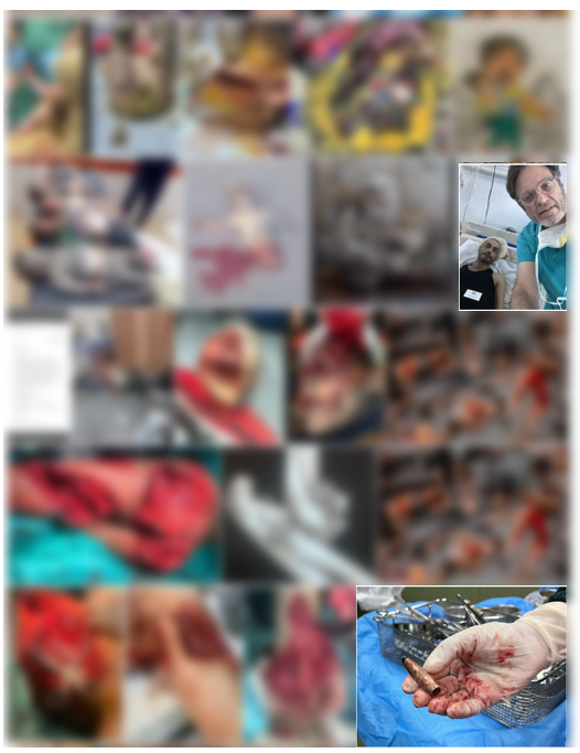 כאן חלק קטן מאלבום התמונות ששלח לי ד"ר מארק פרלמוטר מחוויותיו בעזה. אי אפשר לפרסם כמעט אף אחת מהתמונות האלו, אפילו תיאור מילולי שלהן הוא מזעזע מידי. 
בכתבה שלמטה ראיינתי אותו ואת ד"ר פירוז סידהווה, שניהם חזרו מעזה לפני פחות משבועיים. >>