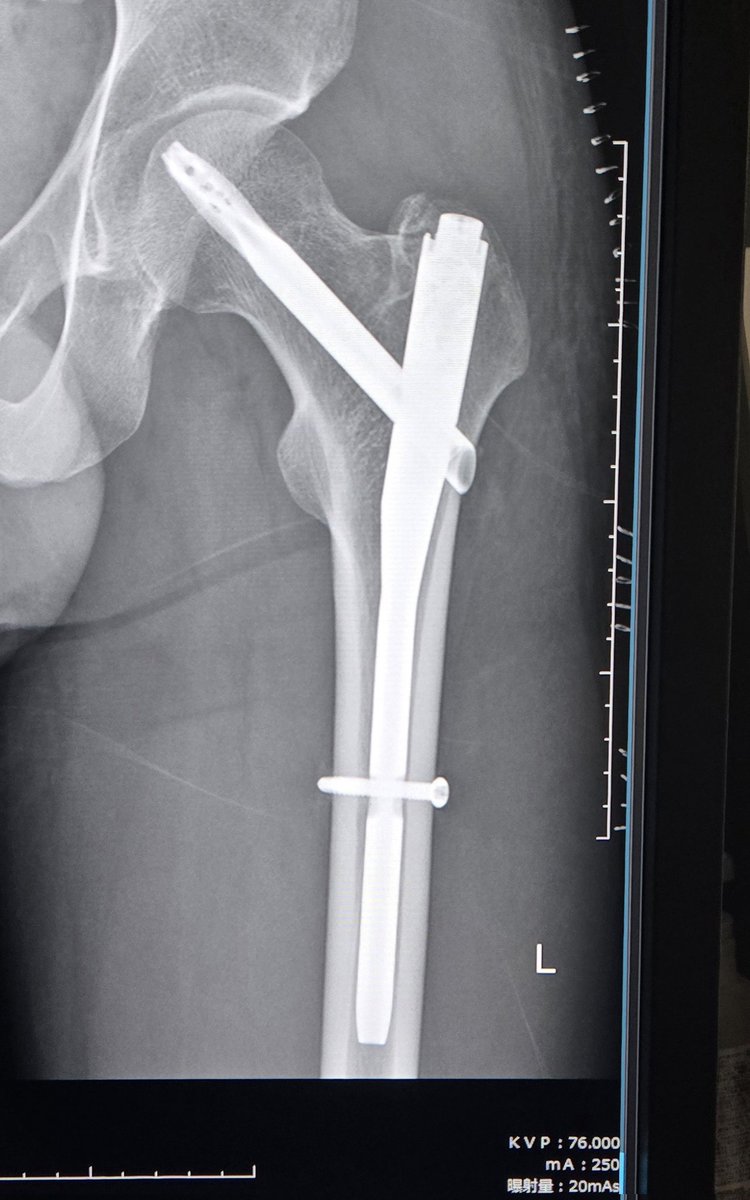 【大腿骨転子部骨折 14日目】
無事に帰国し、今日は骨の確認と医療用ホッチキスを外してもらった！
自分の身体には、こんなに大きなチタン製のスクリューが入っている🔩
骨が治ったら抜いて、チタンブルーにしてオブジェにしようと考えていたが、基本的には一生入れたままらしい😂
リハビリも順調！