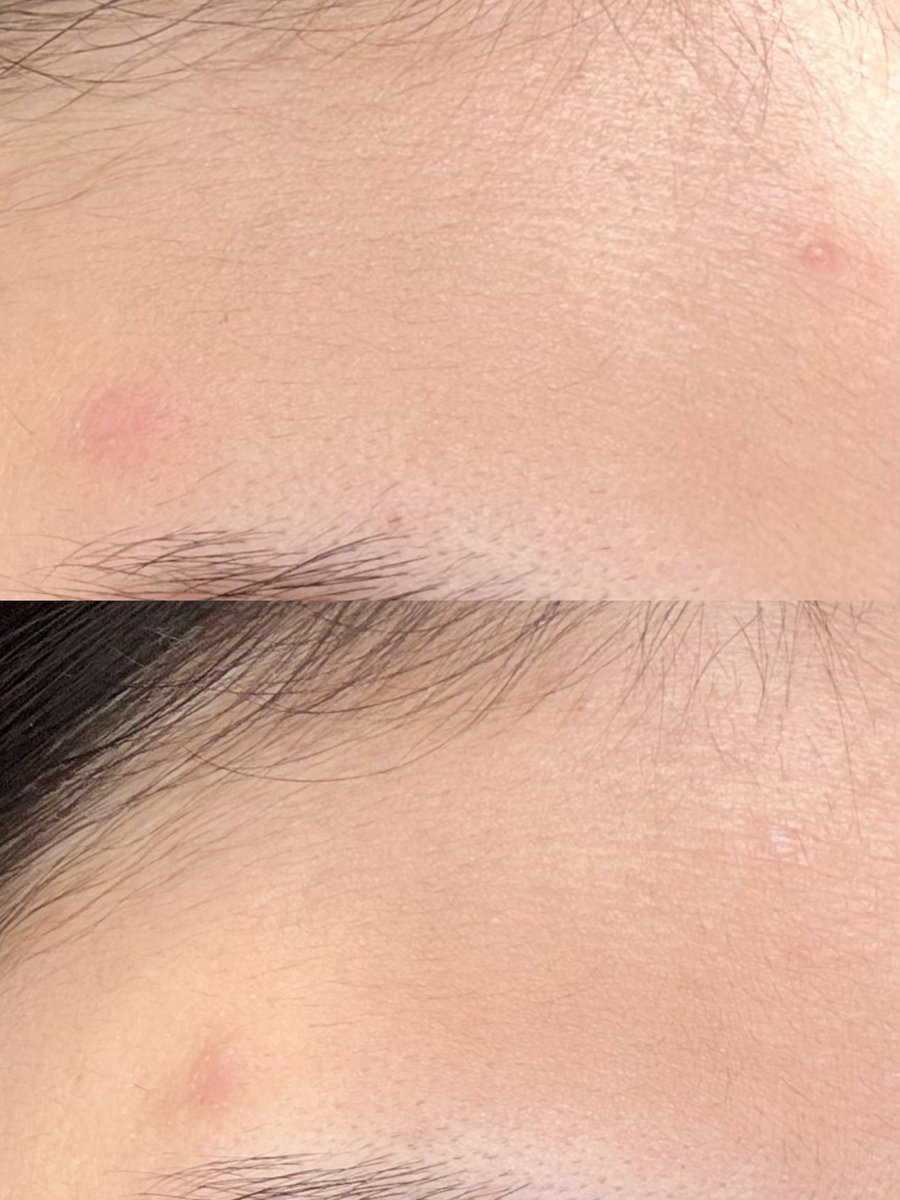 bbrinkk's tweet photo. เพิ่งได้ลองใช้ NIVEA Derma Acne Care สองตัวนิ micellar ที่คลีนเมคอัพเริ่ดมาก ช่วยลดสิวไปในตัว ไม่แสบผิว + gel to foam cleanser เจลล้างหน้าเปลี่ยนเป็นโฟม ล้างสะอาดผิวไม่แห้งเอี๊ยดๆ ผิวดีขึ้นแบบรู้สึกได้ ที่ชอบที่มีส่วนผสมช่วยเรื่องสิวแบบปัง รอยแดงจางลงจริง คือปิดสวิตช์วงจรสิว ให้ผิวมูฟออนใน 7 วันจริงง

#NIVEADermaAcneCare #ปิดสวิตช์วงจรสิวให้ผิวมูฟออนใน7วัน #ป้ายยาสกินแคร์