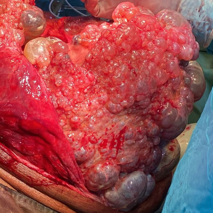 deedee2984's tweet photo. Dear PathX colleagues. What will you call this huge intra-abdominal/hepatic cyst from a late 50s/F? #GIPath #LiverPath @LizMontgomeryMD @DrGeeONE @DrEze_pathology @drlawalm @kriyer68 @ariella8 @TristanRutland7 @zucchiatti_ @ziad_zaatari @DraEosina https://t.co/r2z71VpXDP
