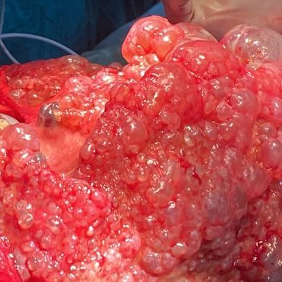 deedee2984's tweet photo. Dear PathX colleagues. What will you call this huge intra-abdominal/hepatic cyst from a late 50s/F? #GIPath #LiverPath @LizMontgomeryMD @DrGeeONE @DrEze_pathology @drlawalm @kriyer68 @ariella8 @TristanRutland7 @zucchiatti_ @ziad_zaatari @DraEosina https://t.co/r2z71VpXDP