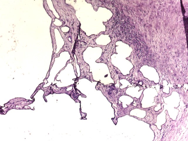 deedee2984's tweet photo. Dear PathX colleagues. What will you call this huge intra-abdominal/hepatic cyst from a late 50s/F? #GIPath #LiverPath @LizMontgomeryMD @DrGeeONE @DrEze_pathology @drlawalm @kriyer68 @ariella8 @TristanRutland7 @zucchiatti_ @ziad_zaatari @DraEosina https://t.co/r2z71VpXDP