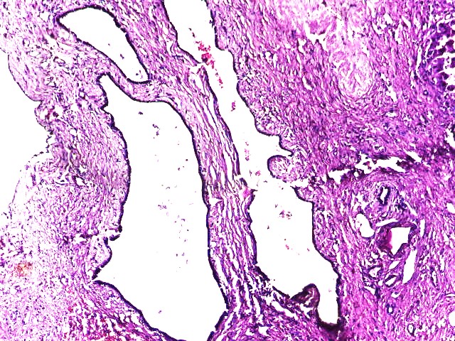 deedee2984's tweet photo. Dear PathX colleagues. What will you call this huge intra-abdominal/hepatic cyst from a late 50s/F? #GIPath #LiverPath @LizMontgomeryMD @DrGeeONE @DrEze_pathology @drlawalm @kriyer68 @ariella8 @TristanRutland7 @zucchiatti_ @ziad_zaatari @DraEosina https://t.co/r2z71VpXDP