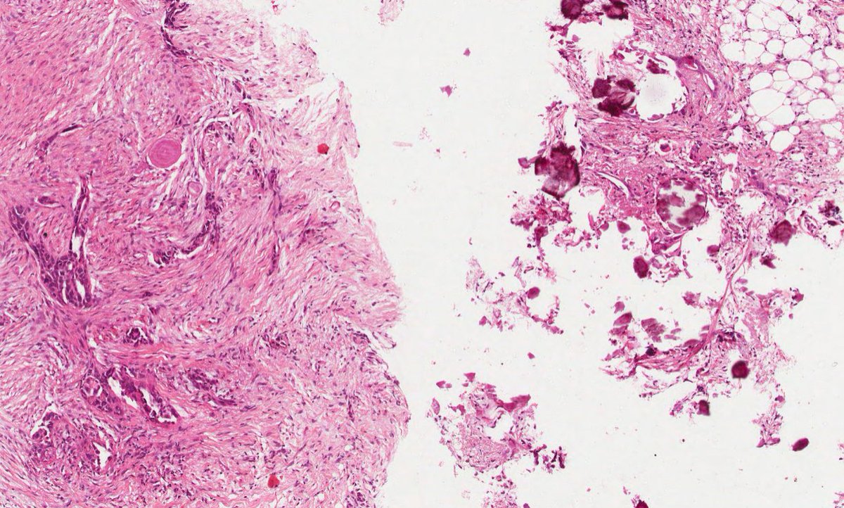 #caseoftheweek #pathX #gynaepath What is causing omental masses in this 58 year old woman? View the full slide on the Leeds Virtual Pathology Website here: virtualpathology.leeds.ac.uk/slides/library…
