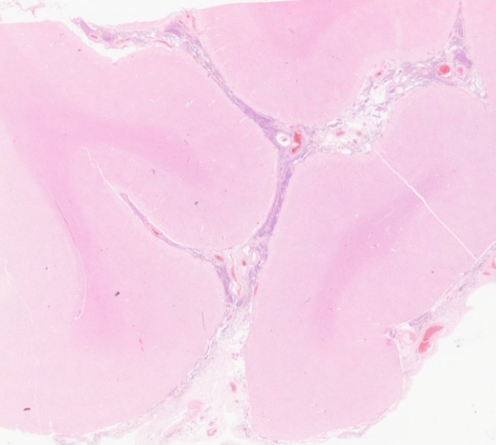 #caseoftheweek What was causing a headache in this 81 year old? #neuropathology #pathX
View the whole slide and thousands of others here virtualpathology.leeds.ac.uk/slides/library… on the Leeds virtual pathology website
