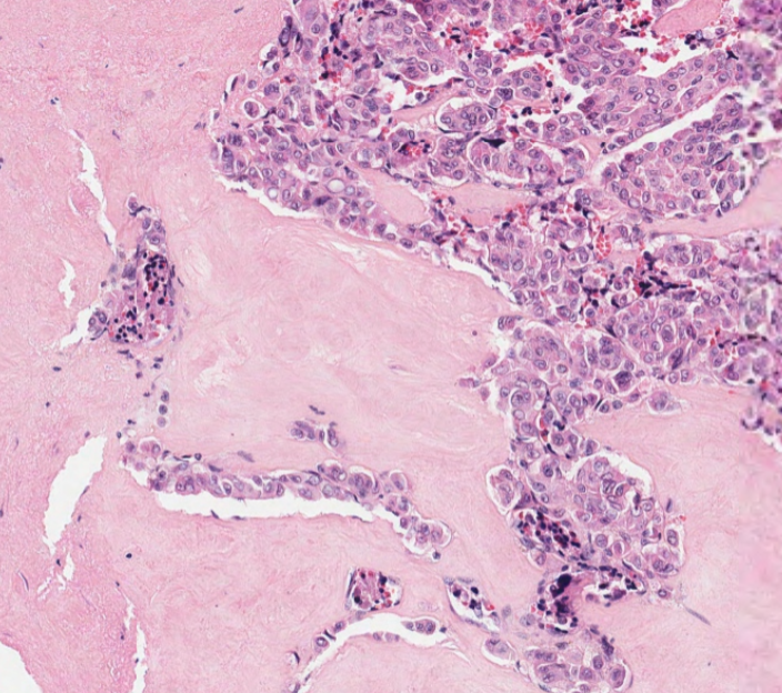 #caseoftheweek #pathX🔬🔬🔬What is this thyroid tumour taken from a 58 year old man? Congo red positive. View the H&amp;E here: virtualpathology.leeds.ac.uk/slides/library… View the FNA here: virtualpathology.leeds.ac.uk/slides/library…