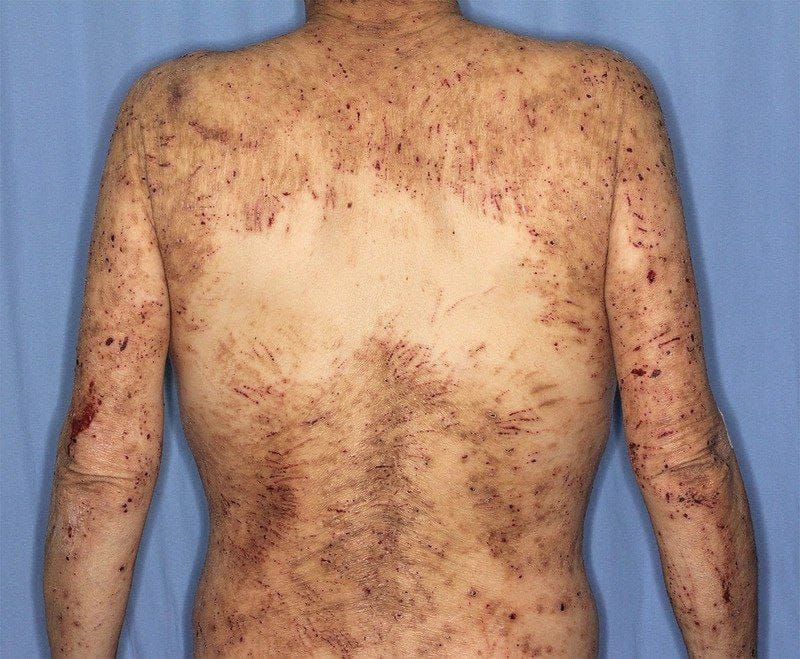 IhabFathiSulima's tweet photo. What is organ Failure is associated ⁉️
A 57 years old with severe itching. https://t.co/KaICJbjlLU